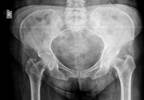 Nurse-Led Fracture Liason Service Cost-Effective for Geriatric Hip Fx Care Nurse-Led Fracture Liason Service Cost-Effective for Geriatric Hip Fx Care