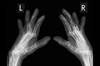 Effects of Sex and Gender on Rheumatoid Arthritis Pathogenesis and Treatment Effects of Sex and Gender on Rheumatoid Arthritis Pathogenesis and Treatment