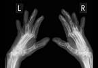 Clinical Outcomes With MTX Monotherapy vs TNFi-MTX Combination Therapy for Early RA Clinical Outcomes With MTX Monotherapy vs TNFi-MTX Combination Therapy for Early RA