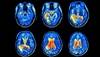 Addressing Psychological Comorbidities in Spondyloarthritis Addressing Psychological Comorbidities in Spondyloarthritis
