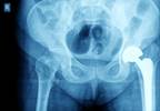 AAOS: Home Recovery After Joint Arthroplasty Better than Inpatient Care AAOS: Home Recovery After Joint Arthroplasty Better than Inpatient Care