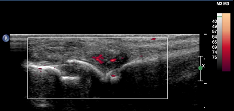 The Use of Musculoskeletal Ultrasound in Rheumatic Diseases