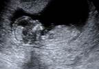 SLE Pregnancy Outcomes Impacted by Maternal Race, Ethnicity SLE Pregnancy Outcomes Impacted by Maternal Race, Ethnicity