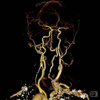 Preclinical cerebrovascular screening may be important in determining stroke risk in individuals with RA. Preclinical cerebrovascular screening may be important in determining stroke risk in individuals with RA.