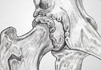 How Does Obesity Affect Arthritis Outcomes? How Does Obesity Affect Arthritis Outcomes?
