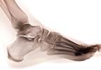 Ultrasound Finds Distinct Ankle Pathologies In Rheumatic Diseases Ultrasound Finds Distinct Ankle Pathologies In Rheumatic Diseases