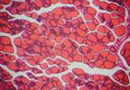 High Prevalence of Autoimmune Thyroid Disease in FM High Prevalence of Autoimmune Thyroid Disease in FM