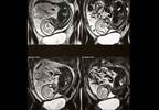 Low Disease Activity in Rheumatoid Arthritis After Tofacitinib Discontinuation Low Disease Activity in Rheumatoid Arthritis After Tofacitinib Discontinuation