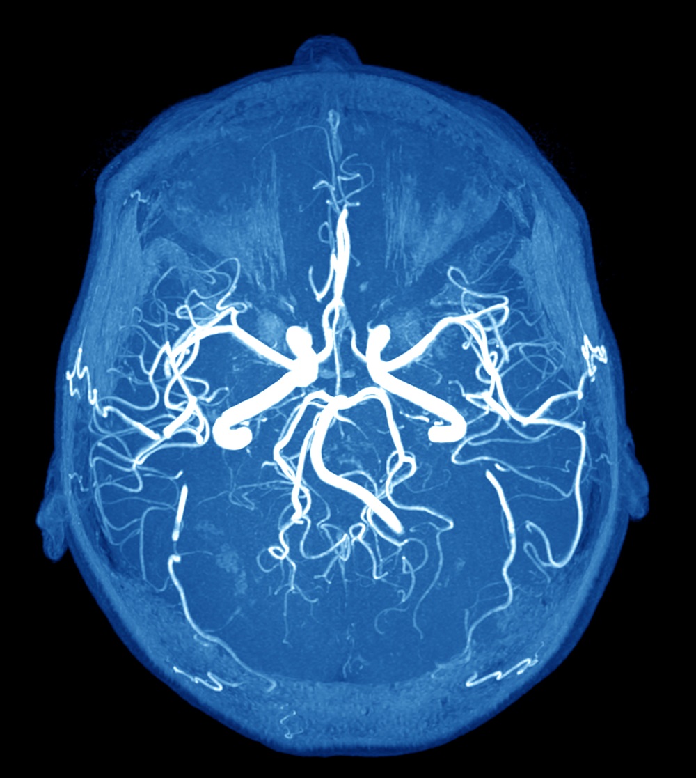 Troponin T and Cerebral Microbleeds in Rheumatic Heart Disease