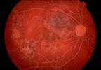 Efficacy, Safety of Adalimumab vs Infliximab in JIA-Associated Uveitis Efficacy, Safety of Adalimumab vs Infliximab in JIA-Associated Uveitis