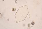 Metoprolol Elevates Serum Uric Acid and Gout Risk in African Americans Metoprolol Elevates Serum Uric Acid and Gout Risk in African Americans