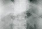 Treatment-Resistant Psoriatic Arthritis Improved by Ixekizumab Treatment-Resistant Psoriatic Arthritis Improved by Ixekizumab