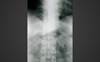 Hitting the Target in Psoriatic Arthritis: Which Outcome Measures Are Best? Hitting the Target in Psoriatic Arthritis: Which Outcome Measures Are Best?