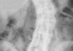 Factors Associated With Neuropathic Pain in Ankylosing Spondylitis Factors Associated With Neuropathic Pain in Ankylosing Spondylitis
