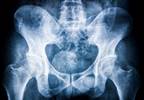 Novel Automated Mobility Measure Yields High Reproducibility in Axial Spondyloarthritis Novel Automated Mobility Measure Yields High Reproducibility in Axial Spondyloarthritis