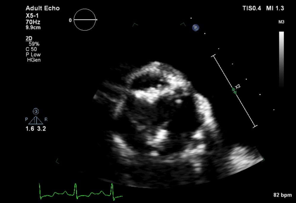 rheumatic-heart-disease-murmer-rheumatic-fever-heart-disease