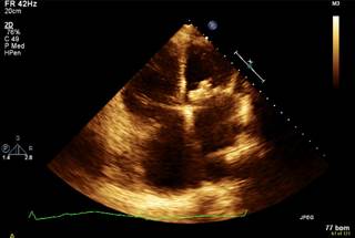 Spotlight on Rheumatic Heart Disease: A Cardiothoracic Surgeon's