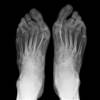 Increased Risk for Diabetes in Patients With Poorly Controlled Rheumatoid Arthritis Increased Risk for Diabetes in Patients With Poorly Controlled Rheumatoid Arthritis
