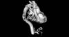 Mitigating Risk of Cardiovascular Disease in Rheumatoid Arthritis Mitigating Risk of Cardiovascular Disease in Rheumatoid Arthritis