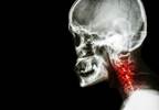 Cervical BME Correlates With Neck Pain in RA and AS Cervical BME Correlates With Neck Pain in RA and AS