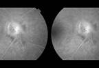 Uveitis Flares In Axial Spondyloarthritis Controlled With Certolizumab Pegol Uveitis Flares In Axial Spondyloarthritis Controlled With Certolizumab Pegol