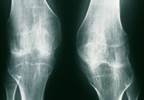 Anti-Tumor Necrosis Factor Agents vs csDMARDs for Pediatric Enthesitis-Related Arthritis Anti-Tumor Necrosis Factor Agents vs csDMARDs for Pediatric Enthesitis-Related Arthritis