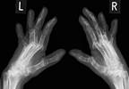Tender Joint Count May Not Reflect Inflammation Activity in Rheumatoid Arthritis Tender Joint Count May Not Reflect Inflammation Activity in Rheumatoid Arthritis