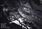 Greater AS Partial Remission With IFX + NSAID vs NSAID Monotherapy Greater AS Partial Remission With IFX + NSAID vs NSAID Monotherapy