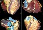 Clinician Roundtable: Statins for CV Risk Reduction in Rheumatoid Arthritis Clinician Roundtable: Statins for CV Risk Reduction in Rheumatoid Arthritis