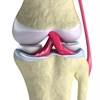 Modifiable Psychological Factors Influence TKA for OA Modifiable Psychological Factors Influence TKA for OA