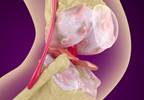 Osteoporosis Treatment Receives Updated Guidelines From ACP Osteoporosis Treatment Receives Updated Guidelines From ACP