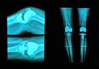 Impact of Modifiable Psychological Factors on TKA for OA Impact of Modifiable Psychological Factors on TKA for OA