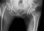 Fractures in Older Men Predicted by Low DHEAS Serum Levels Fractures in Older Men Predicted by Low DHEAS Serum Levels