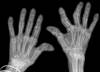 Exploring the Link Between Metabolic Syndrome and Rheumatoid Arthritis Exploring the Link Between Metabolic Syndrome and Rheumatoid Arthritis