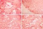 Psoriasis Among Skin Diseases With Largest Impact on Well-Being Psoriasis Among Skin Diseases With Largest Impact on Well-Being