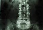 Treatment Efficacy and Clinical Burden in Nonradiographic Axial Spondyloarthritis vs Ankylosing Spondylitis Treatment Efficacy and Clinical Burden in Nonradiographic Axial Spondyloarthritis vs Ankylosing Spondylitis