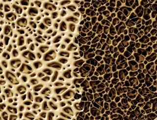 Treatment with testosterone for 1 year improved bone mineral density in older men. Treatment with testosterone for 1 year improved bone mineral density in older men.