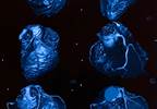 Increased Prevalence of Coronary Atherosclerosis in Psoriatic Arthritis Increased Prevalence of Coronary Atherosclerosis in Psoriatic Arthritis