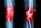 Weight Loss Reduces Knee Cartilage Degeneration In Patients at Risk for Osteoarthritis Weight Loss Reduces Knee Cartilage Degeneration In Patients at Risk for Osteoarthritis