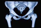 Alzheimer's Disease Identified as Risk Factor for Major Hip Fracture Alzheimer's Disease Identified as Risk Factor for Major Hip Fracture