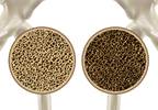FDA Approves Second-Generation Osteoporosis Detection Device FDA Approves Second-Generation Osteoporosis Detection Device