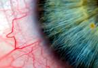 ACR/EULAR Develop Classification Criteria for Primary Sjögren Syndrome ACR/EULAR Develop Classification Criteria for Primary Sjögren Syndrome