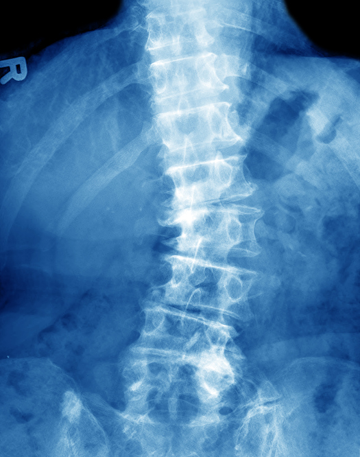 ASAS/EULAR Revise Axial Spondyloarthritis Management Recommendations