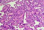 Thyroid Cancer Survivors Face Long-Term Osteoporosis and CVD Risks Thyroid Cancer Survivors Face Long-Term Osteoporosis and CVD Risks