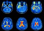 Cognitive Dysfunction, Memory Impairment Evaluated by fMRI in Non-Neuropsychiatric SLE Cognitive Dysfunction, Memory Impairment Evaluated by fMRI in Non-Neuropsychiatric SLE