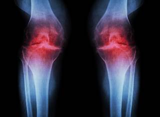 Data were collected from the Osteoarthritis Initiative to examine the relationship between knee osteoarthritis and hypertension. Data were collected from the Osteoarthritis Initiative to examine the relationship between knee osteoarthritis and hypertension.