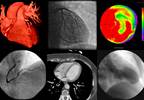 Cardiovascular Magnetic Resonance Tomography May Detect Cardiac Complications in SLE Cardiovascular Magnetic Resonance Tomography May Detect Cardiac Complications in SLE