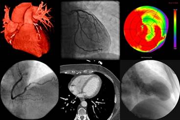 CMR May Detect Cardiac Complications in Lupus CMR May Detect Cardiac Complications in Lupus
