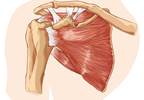 Addressing Cardiovascular Disease Risks May Prevent Shoulder Tendinitis Addressing Cardiovascular Disease Risks May Prevent Shoulder Tendinitis