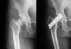 Alendronate Lowers Risk of Hip Fracture in Older Patients Alendronate Lowers Risk of Hip Fracture in Older Patients